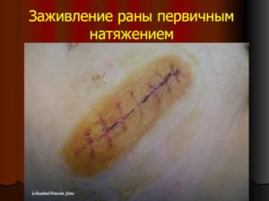 Сфинктеролеваторопластика, незаживающая рана