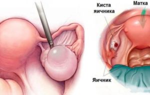 Боли в груди и киста левого яичника