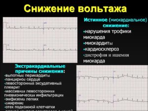 Экг. Снижен вольтаж