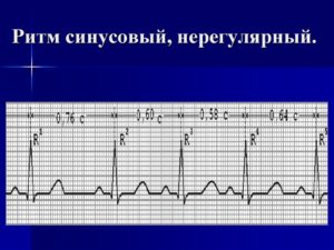 Тахисистолия, нерегулярный синусовый ритм