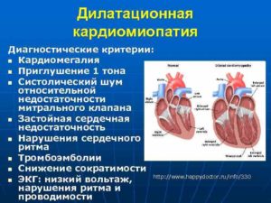 Кардиомегалия плода, кардиомиопатия