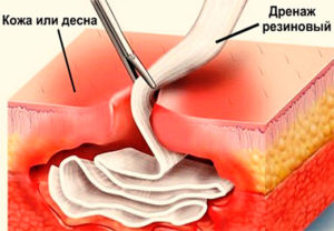 Незаживающая полость после вскрытия абсцесса