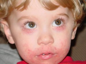 Периоральный дерматит у ребенка