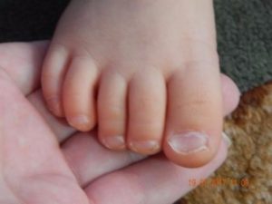 Ногти на ногах ребенка неправильной формы