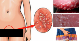 Зуд малых половых губ и входа во влагалище