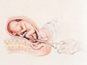 Беременность после искусственных родов