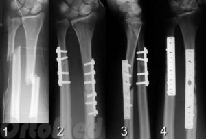 Перелом руки обеих костей