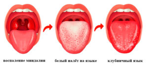 Белый налет на миндалинах и языке