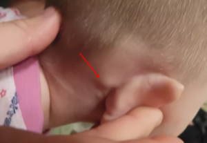 Выпирает кость за ухом у ребенка