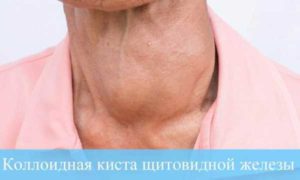 Отсутствие щитовидной железы, остеохондроз