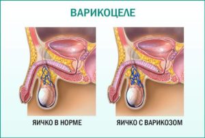 Возникновение варикоцеле от мастурбации