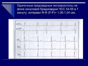 Экстрасистолия на фоне брадикардии