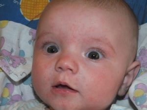 Высыпания на лице у ребёнка 1 месяц