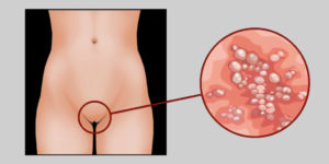 Высыпания на половых губах при беременности