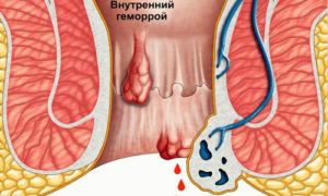 Возле ануса опухоль