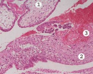 Ворсины хориона с некрозом