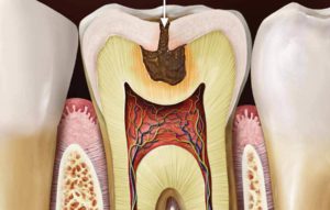 Почему внутри зуба темная полость