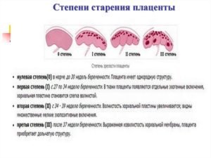 Старение плаценты на 28 неделе беременности
