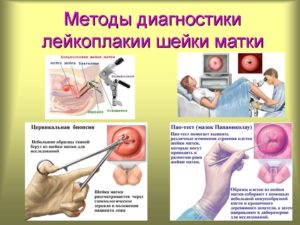 Лейкоплакия шейки матки, ваше мнение