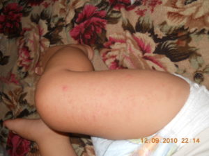 Аллергия на пантогам