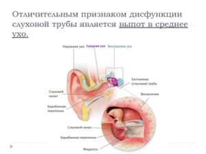 Двусторонняя дисфункция слуховых труб