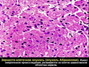 Зернисто клеточная опухоль Абрикосова