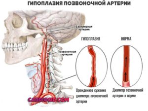 Грыжа и гипоплазия позвоночной артерии