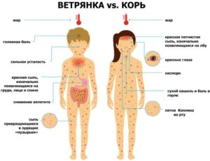 Сильные головные боли при ветрянке