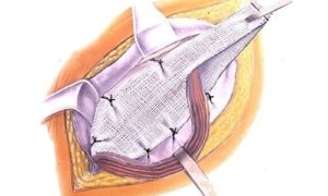 Послеоперационный период после лечения паховой грыжи по Лихтенштейну