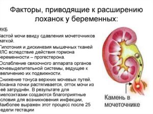 Пиелоэктазия правой почки у беременной