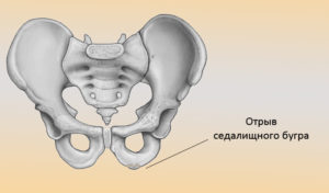 Седалищный бугор