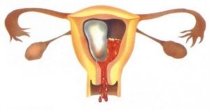 Болит низ живота после выкидыша и чистки