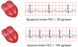 Брадисистолия