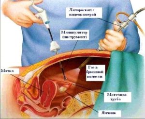 Температура после лапароскопии