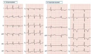 Депрессия сегмента st (2,3, avf). v4-v6