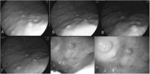 Воспалительные гиперпластические папулы в антральном отделе желудка