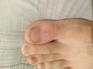 Болячка на пальце ноги