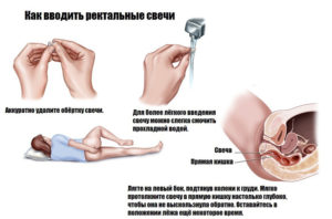 Опасны ли ректальные свечи, если были введены вагинально?
