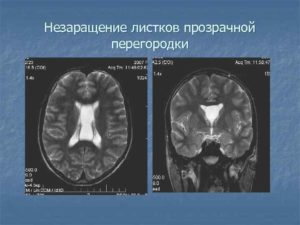 Незаращение листков прозрачной перегородки головного мозга