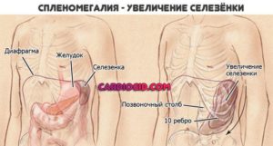 Увеличенная селезенка в 2 раза и лейкоциты 45,37 говорят о онкологи?