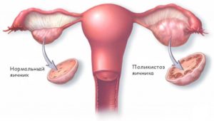 Задержка месячных при поликистозе