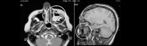 Видно ли на МРТ мозга пазухи носа и возле уха