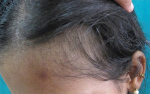 Прием эутирокса и выпадение волос сильное