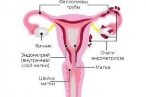 Возможна ли беременность при маленьком эндометрии