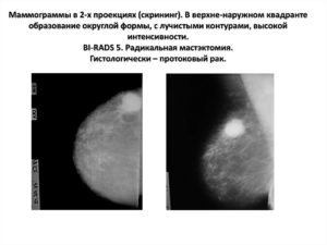 Уплотненный участок м/ж без четких контуров в верхнем-наружном квадранте