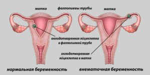 Возможны ли месячные при беременности