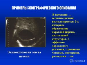 Округлое образование в s4 сегменте печени