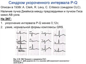 Укорочение интервала pq на экг