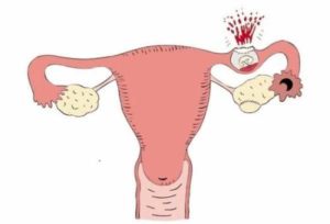 Планирование беременности с маточной перегородкой