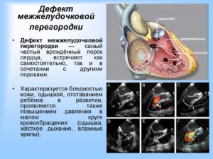 ВПС. ДМЖП. НК 1 ст. Возможно самостоятельное закрытие?